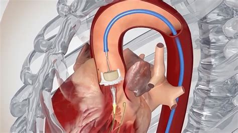 life expectancy after aortic valve replacement - Ulrike Geiger