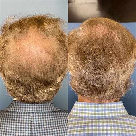 Hair Restoration in Clearwater, FL | Skinology