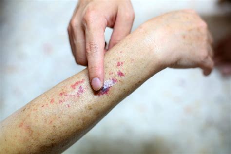 CAD Patients With Chronic Rashes Want More Answers - Rare Disease Advisor