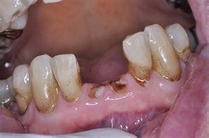 Do tooth roots need to be removed | News | Dentagama