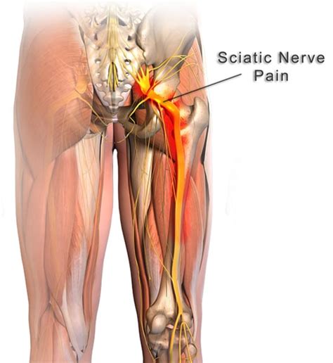 How to Relieve Sciatic Nerve Pain – APTOCO.COM