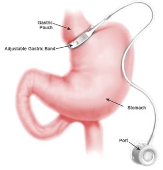 Gastric Banding or Lap Band® Surgery