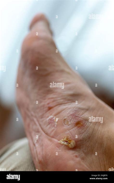 Scab and itchy hi-res stock photography and images - Alamy