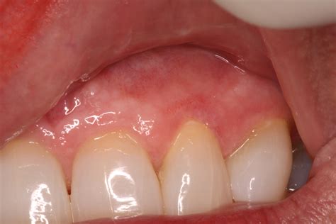 Gum Infection