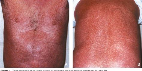 Figure 2 from Treatment of telangiectasia macularis eruptiva perstans with total skin electron ...