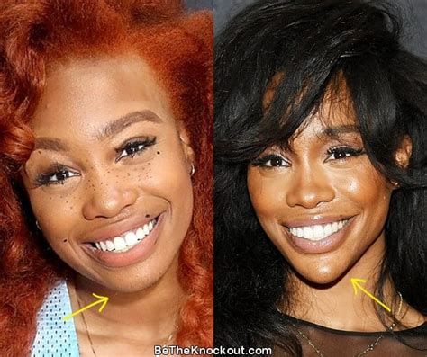 SZA Plastic Surgery Comparison Photos