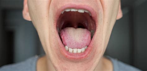 What should your tonsils look like? - Chloralieve