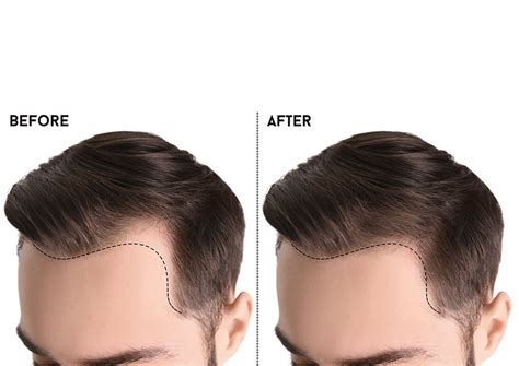 Home - RegenRx Hair Restoration