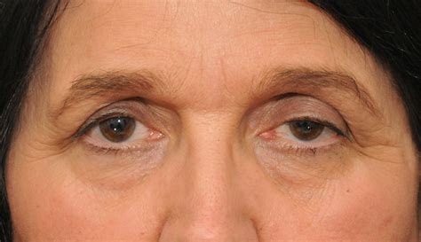 7 Reasons Why One of Your Eyes Is Smaller Than the Other - TSMP Medical Blog