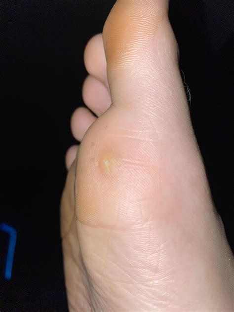 What is this little bump that has developed on my foot? : DiagnoseMe