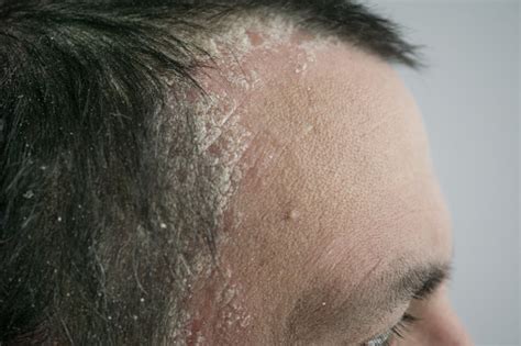 Psoriasis On The Hairline And On The Scalpclose Up Dermatological ...