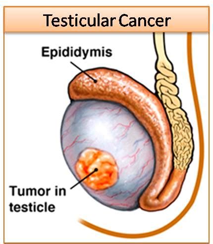 Testicular Cancer: Symptoms, Treatment, Testicular Self Examination