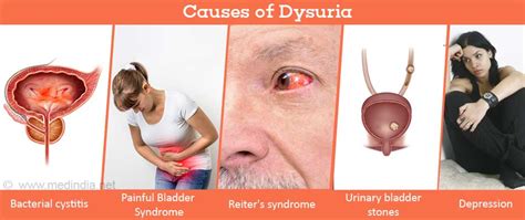 Dysuria | Painful Micturition | Painful Urination - Symptom Evaluation