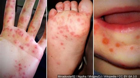 Hand, foot and mouth disease outbreak hits Johns Hopkins University