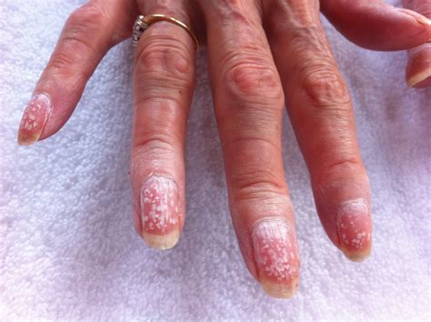 Latest Trends In How Do You Know If You're Allergic To Gel Nails 2023 | Alice Napier Journal Blog