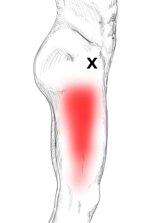 Pain And Injury In The Tensor Fasciae Latae Muscles Stock Illustration ...