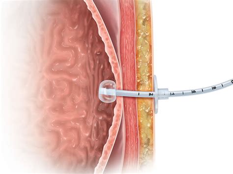 Understanding your feeding tube | Cook Medical