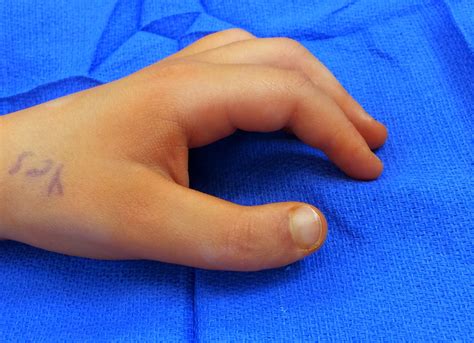 Triphalangeal Thumb | Congenital Hand and Arm Differences | Washington University in St. Louis