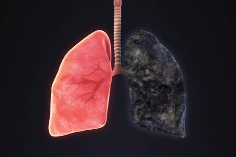 Emphysema: Causes, Symptoms & Treatment Options