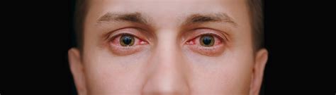 Why Allergies Make Your Eyes Red and Itchy - Cliradex®