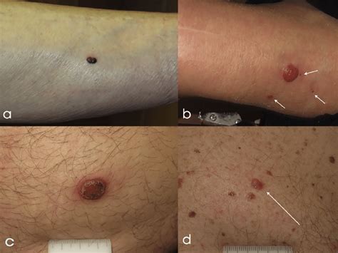 Nodular Melanoma Red