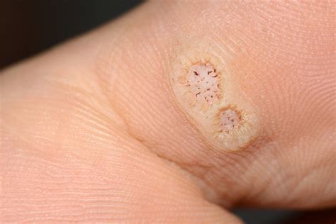 Planter Warts - Everything You Need To Know | APDerm