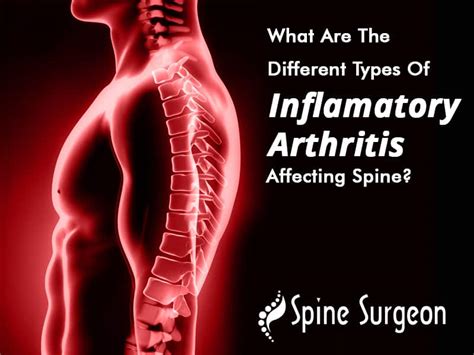 What Are The Different Types Of Inflammatory Arthritis Affecting Spine? | Spine Surgeon