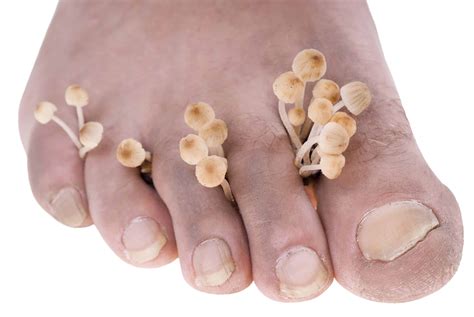 Fungal Nail Infection-5 Questions to ASK - A Step Ahead Foot + Ankle Care