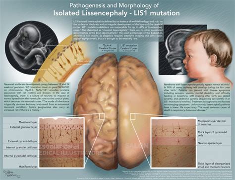 Pathology of Isolated LIS1 Lissencephaly | AMI Meeting 2021