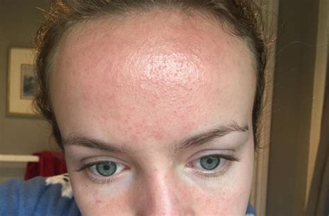 Big rash on forehead 1.5 months after accutane finished - Accutane (isotretinoin) logs - Acne.org