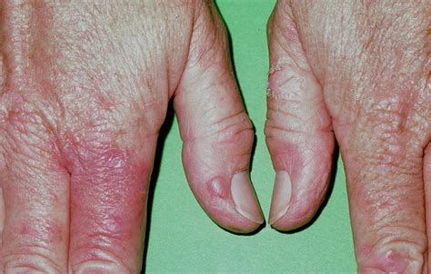 pseudoporphyria - pictures, photos