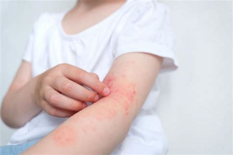 What Causes Atopic Dermatitis in Adults?: Seacoast Dermatology: Dermatology Clinic