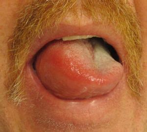 Angioedema - WikEM