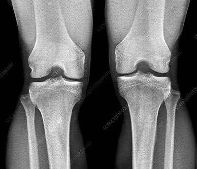 Normal knees, X-rays - Stock Image - F011/7590 - Science Photo Library