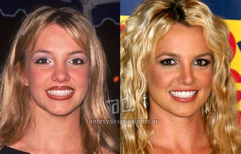 britney spears rhinoplasty | Celebrity plastic surgery, Rhinoplasty, Plastic surgery