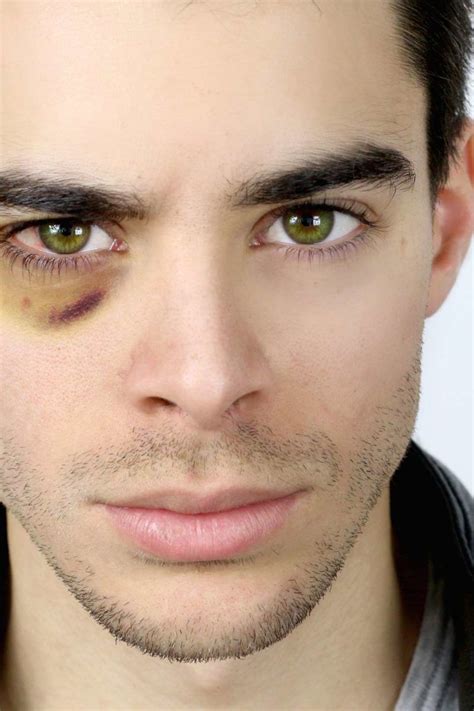 Black eye: Causes, effects, treatment, and prevention