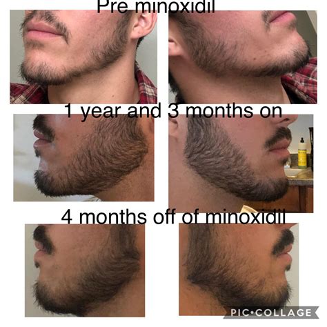 Minoxidil Before And After Beard Result : How To Use Minoxidil Solution The Best Way To Apply ...