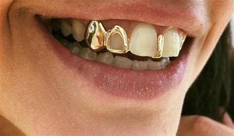 What are Dental Grills and Is It Safe to Use Them?