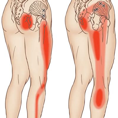 Gluteus Medius Trigger Point