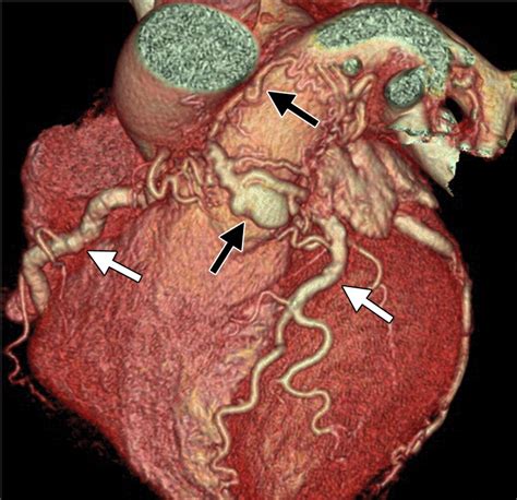 Coronary Artery