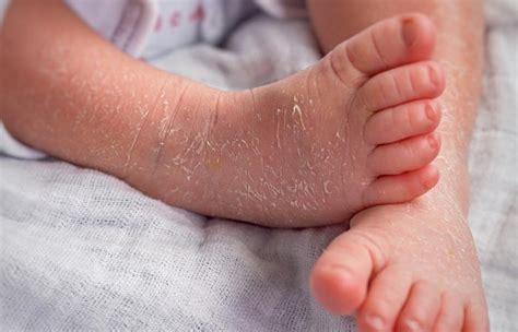 Ichthyosis Vulgaris – 원인, 증상 및 치료 - 최신