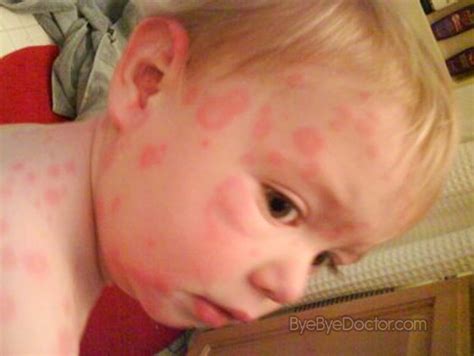 fifths disease rash pictures - pictures, photos