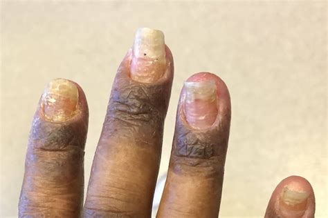 Inflammation and Redness of the Fingernail Folds - Clinical Advisor