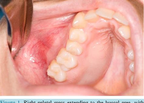 Figure 1 from Extensive Odontogenic Myxoma of the Maxilla: A Case Report and Review of ...