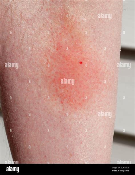 Wasp sting and surrounding irritation on shin Stock Photo - Alamy