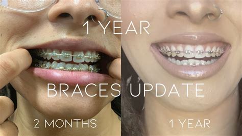 1 Year of Gold Braces | Update | Partial Power Chains | New Band Color | Montage | KhadijahTiana ...