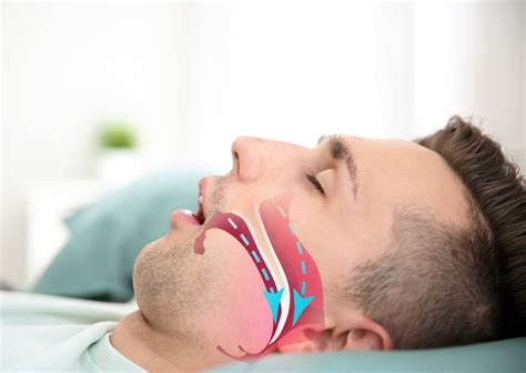 Apnea del sueño: tratamiento con férulas de avance mandibular