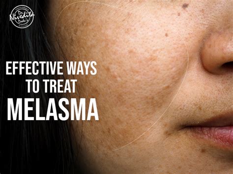 Melasma: Causes, Symptoms, Treatment