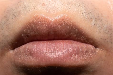 Fordyce Spots: Symptoms, Causes, Treatment On Lips, 54% OFF