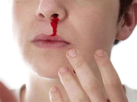 Epistaxis - All You Need To Know - Health Synonyms